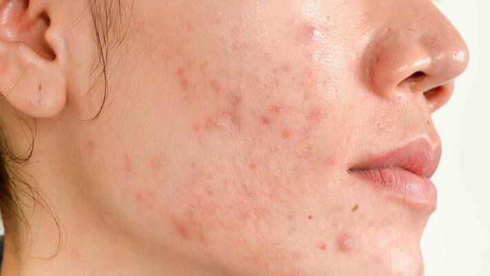 Home remedies to remove cystic acne ABSC Home remedies to remove cystic acne ABSC