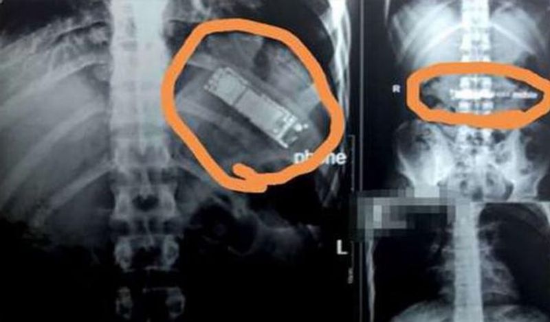 मामला इजिप्ट से सामने आया जहां एक शख्स प्रैंक के चक्कर में हर लिमिट क्रॉस कर गया। वो अपने दोस्त के साथ ये प्रैंक कर रहा था। इसमें वो मोबाइल को निगल कर उसकी घंटी दोस्त को अपने पेट से आते हुए सुनाना चाहता था। 