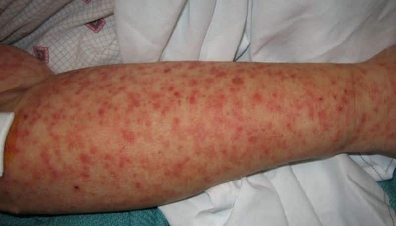 know about the symptoms of chapare virus
