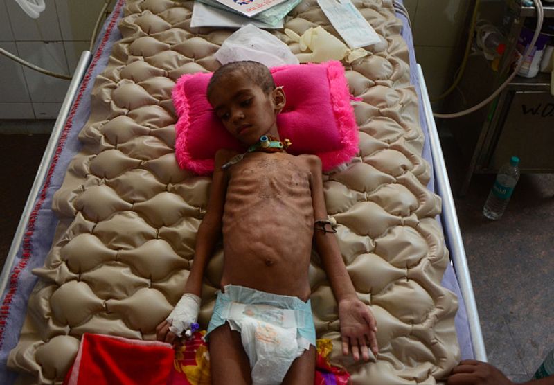 What is Guillain Barre Syndrome, that 24 Covid patients in Mumbai developed ALB