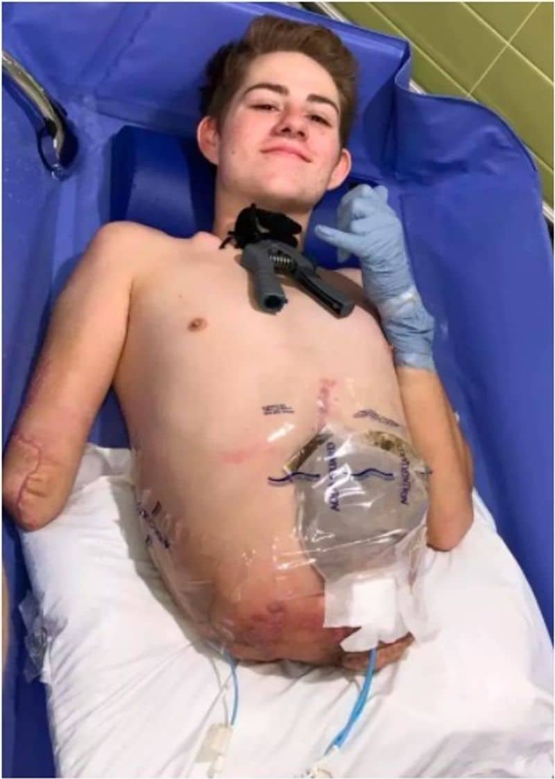 Teenager Chooses To Amputate Bottom Half Of Body To Save His Life dpl