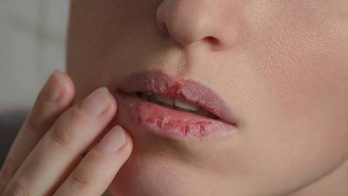 three home remedies to prevent chapped lips three home remedies to prevent chapped lips