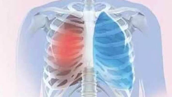 First successful lung transplant of Kovid patient in Delhi kpn First successful lung transplant of Kovid patient in Delhi kpn