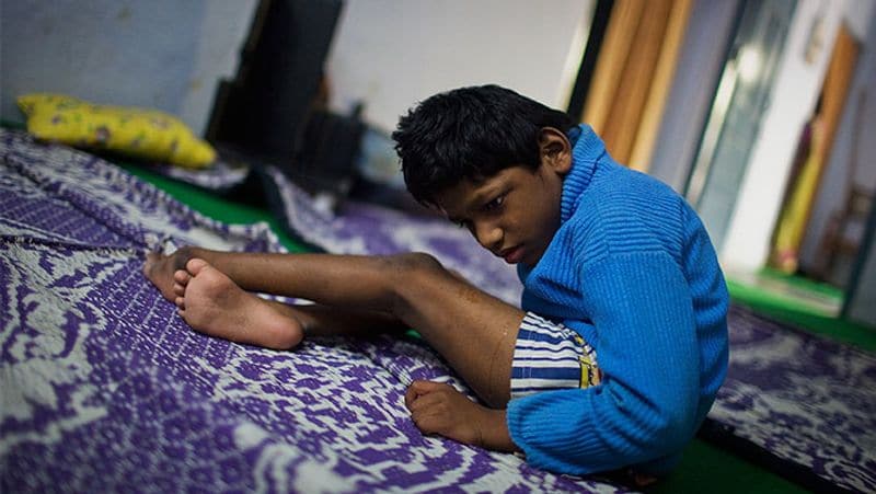भोपाल में ऐसे एक नहीं, कई बच्चे हैं...जो गैस कांड का दंश झेल रहे हैं।