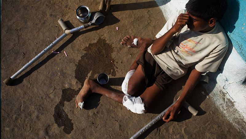 गैस के असर से बच्चों में विकलांगता देखी गई।