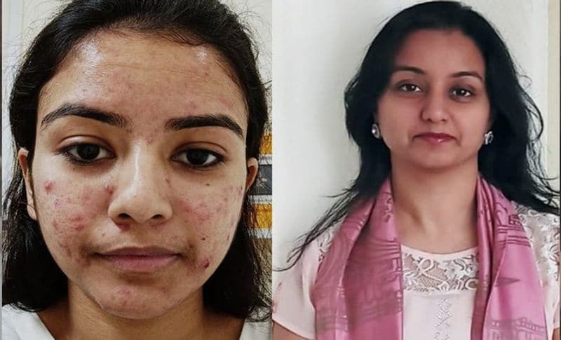 तस्वीर में दिखाई दे रहीं यह लेडी अहमदाबाद के अपोलो हॉस्पिटल की नर्स किंजल कोराट हैं। जिन्होंने सेफ्टी के लिए पहने डबल मास्क से चेहरे की स्किन खराब हो रही है। उनका कहना है कि जब मैंने पहली बार पीपीई किट पहनी तो गर्मी और पसीने के चलते चेहरे और शरीर में जगह-जगह लाल चकत्ते और फफोले उठ आए। जो बुरे लगने की जगह दर्द भी देने लगे। अब आलम यह है कि इसका इलाज करना पड़ रहा है। 