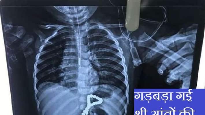 One and a half year old child swallows beads of pearl in Lucknow asa One and a half year old child swallows beads of pearl in Lucknow asa
