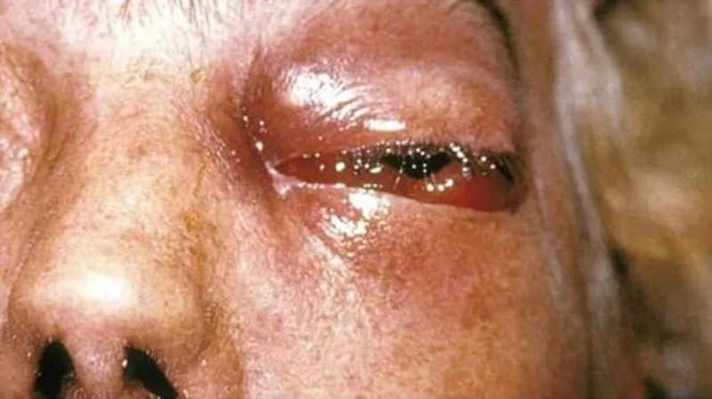 Mucormycosis new complications in Covid patients in Delhi, Mumbai and Ahmedabad ALB