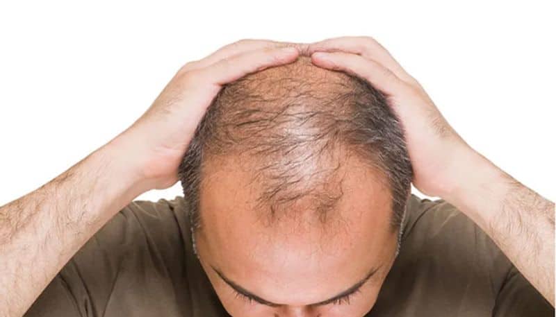 Hair loss remedy tips for men