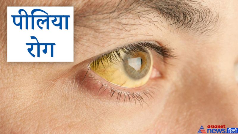 6. पीलिया रोग
यदि व्यक्ति को बुध रेखा पर नक्षत्र चिह्न एवं द्विप चिह्न हो और उसी स्थान पर काला धब्बा हो तो व्यक्ति को पीलिया रोग हो सकता है।