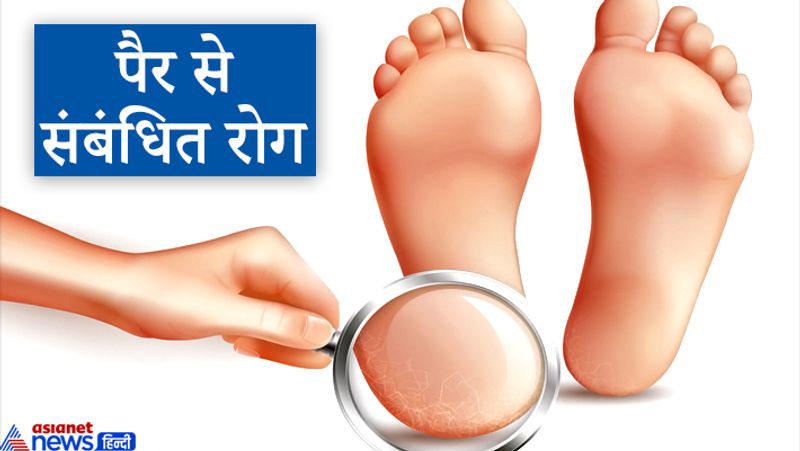 8. पैर से संबंधित रोग
जिस की हथेली में शनि पर्वत उच्च हो एवं रेखाएं भी अधिक हों तथा मस्तिष्क रेखा शनि पर्वत के नीचे टूट जाए तो व्यक्ति को पैरों में दर्द अथवा पैर से संबंधित रोग हो सकते हैं।