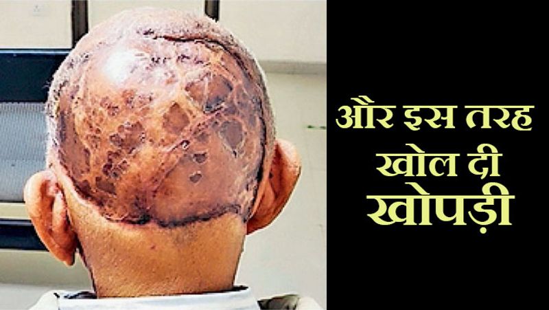 बेसल सेल कार्सिनोमा एक तरह का कैंसर है, जो स्किन के ऊपरी हिस्से में होता है। यह मानव शरीर की बेसल सेल कार्सिनोमा कोशिकाओं में होता है। ये कोशिकाएं नई त्वचा कोशिकाओं को जन्म देती हैं। बता दें कि शरीर में निरंतर पुरानी कोशिकाएं मरती रहती हैं और उनकी जगह नई कोशिकाएं लेती रहती हैं।