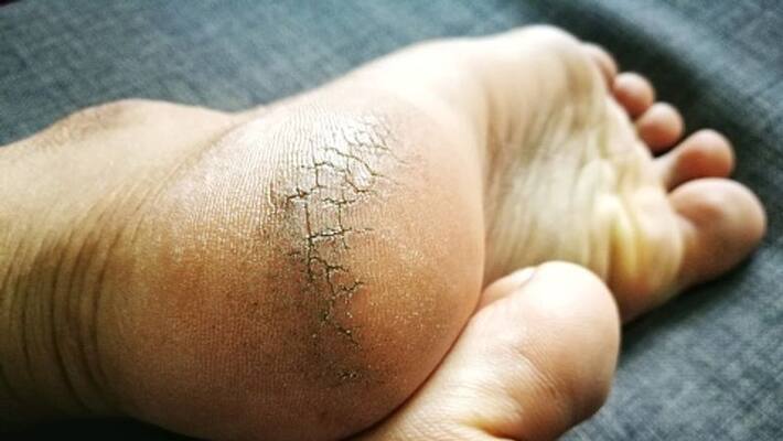 Facing crack heels problems then use this home remedies BDD Facing crack heels problems then use this home remedies BDD
