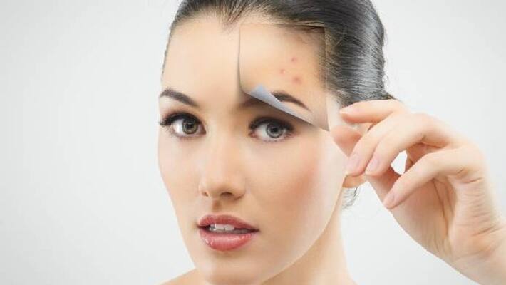 Tips That May Help To Reduce Acne Tips That May Help To Reduce Acne