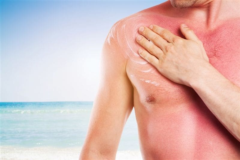 Sunburn is the most commonly occurring health issue and while it may not appear to be as serious as the aforementioned health problems, there is an urgent need to protect oneself from this problem and prevent it from happening in the first place as prolonging it could result in irreversible damage to one's skin.
