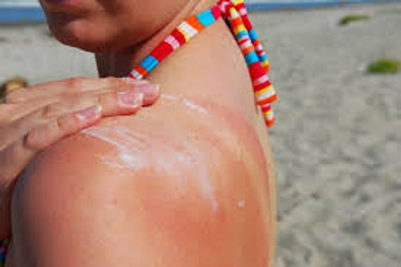 A sunburn could be classified into two kinds. While a mild sunburn includes symptoms like reddening of the skin, itching and skin irritation, chronic sunburn includes swelling, fever, peeling of the skin as well as dehydration in severe cases. Apart from long term exposure to the dangerous radiation of the sun, excessive use of chemical products like creams, deodorants and other cosmetic products deplete the natural oils of the skin, making it more vulnerable to the ill effects of the ultraviolet rays.