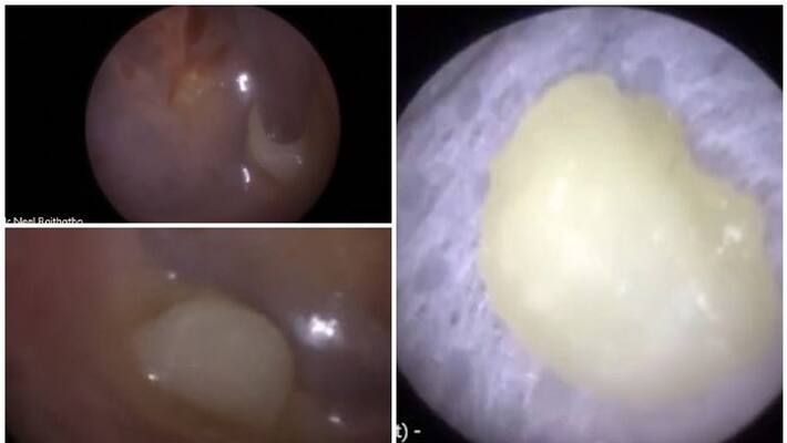 ear specialist has shared the moment he removes a baby tooth that is stuck to a three year olds eardrum ear specialist has shared the moment he removes a baby tooth that is stuck to a three year olds eardrum