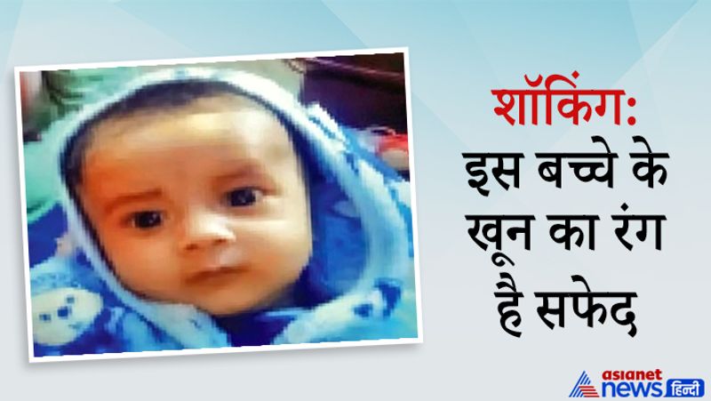 पूरे प्रदेश में ऐसा अब तक पहला मामला
दरअसल, कुछ दिन पहले जेके लोन अस्पताल में यह बच्ची इलाज के लिए आई हुई है। जो कि महज तीन महीने की उम्र का है, माता-पिता ने उसका नाम हिना रखा हुआ है। जब इस बच्ची की बीमारी के बारे में डॉक्टरों को पता चला तो वह शॉक्ड थे। कई का तो कहना था कि हमने पूरी जिंदगी में ऐसा बच्चा क्या कोई इंसान नहीं देखा जिसका खून लाल की जगह सफेद हो। वहीं सीनियर डॉक्टरों का कहना है कि इस हॉस्पिटल में ऐसा यह पहला मामला देखने को मिला है।
