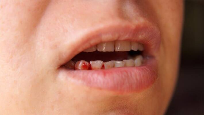 Facing Gum bleeding problem then follow these oral care tips BDD Facing Gum bleeding problem then follow these oral care tips BDD