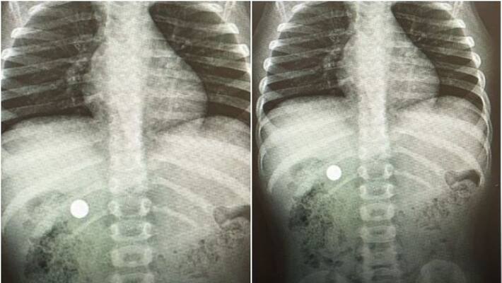 three year old Child saved after swallowing battery in bahrain three year old Child saved after swallowing battery in bahrain