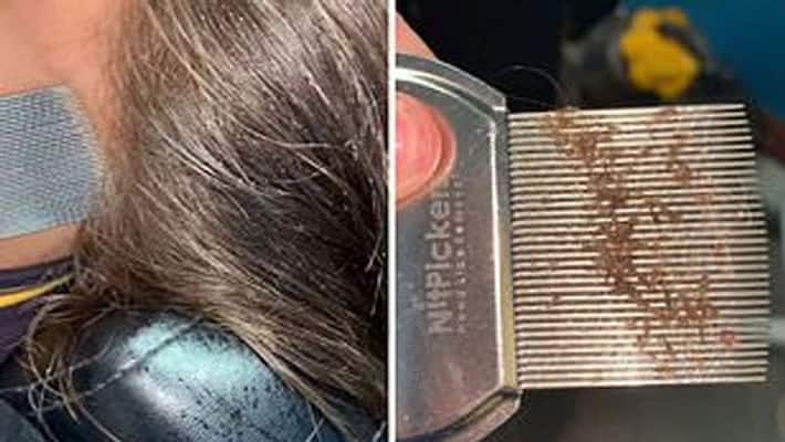 To Get Rid Of Head Lice, Just Follow This Easy Home Remedy, The Nits Will Also Be Cleaned bpsb To Get Rid Of Head Lice, Just Follow This Easy Home Remedy, The Nits Will Also Be Cleaned bpsb