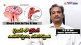 reasons for brain hemorrhage, diagnosis and cure