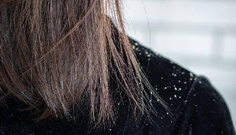 how to get rid of dandruff and hair fall at home easily