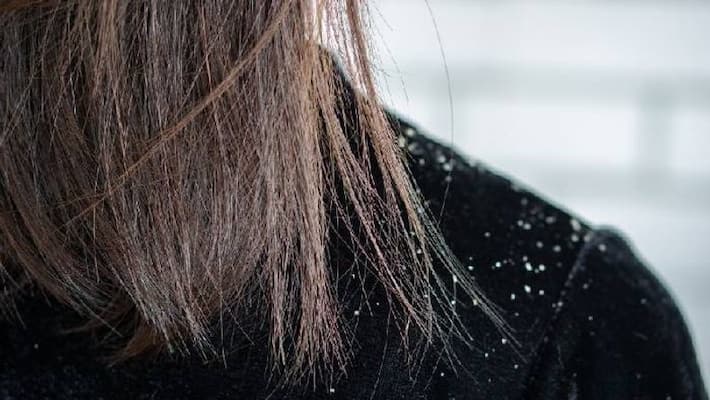 natural home remedies for dandruff natural home remedies for dandruff