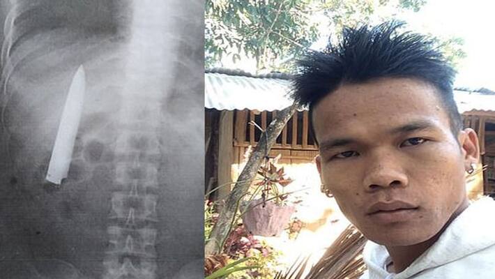 xray report reveals huge steel knife in mans chest buried from 15 months kph xray report reveals huge steel knife in mans chest buried from 15 months kph