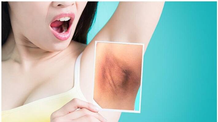 Home Remedies To Help You Deal With Dark Underarms Home Remedies To Help You Deal With Dark Underarms