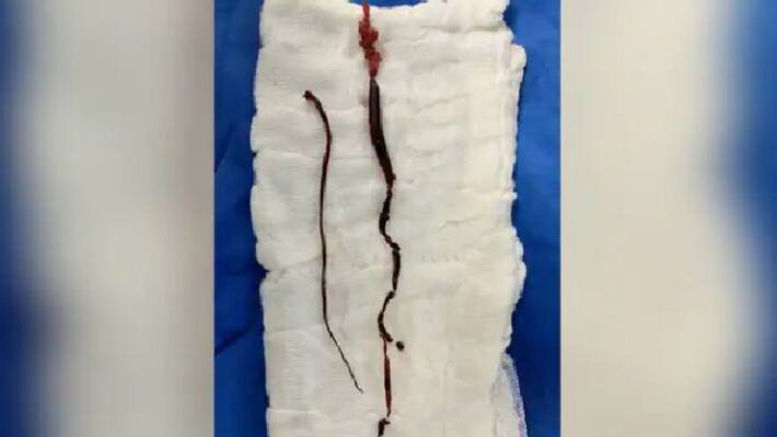 know things about blood clots in covid patients and its connection with heart attack know things about blood clots in covid patients and its connection with heart attack