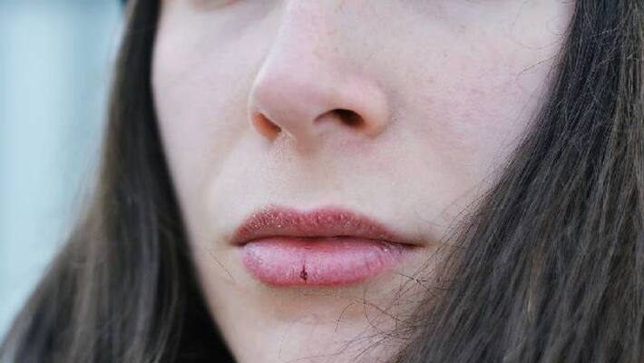 how to get rid Of Chapped and Dry Lips how to get rid Of Chapped and Dry Lips
