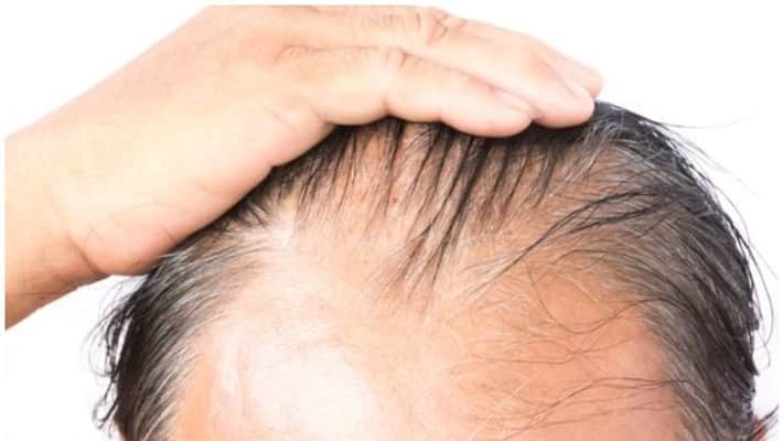 Gene Tied to Balding May Also Raise covid Risks for Men Gene Tied to Balding May Also Raise covid Risks for Men
