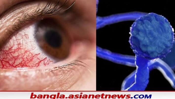 A retired teacher from Murshidabad has been infected with Black Fungus RTB A retired teacher from Murshidabad has been infected with Black Fungus RTB