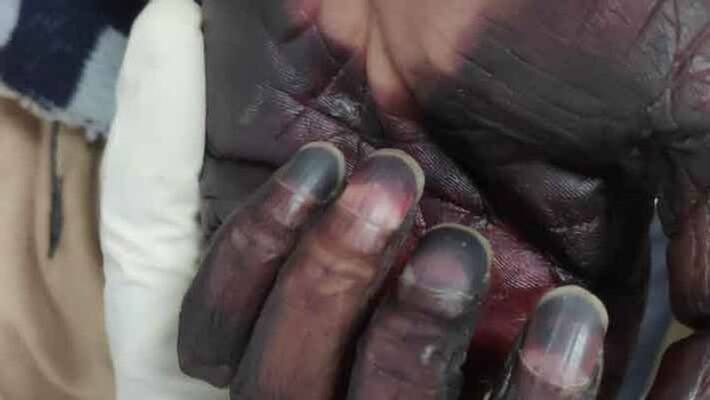 Black Fungus Cases Grow 150 pc In 3 Weeks To 31000 Deaths Over 2100 pod Black Fungus Cases Grow 150 pc In 3 Weeks To 31000 Deaths Over 2100 pod
