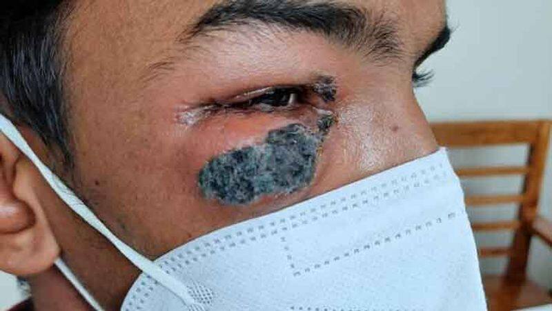 Eye removal of a 26-year-old man suffering from a black fungal infection