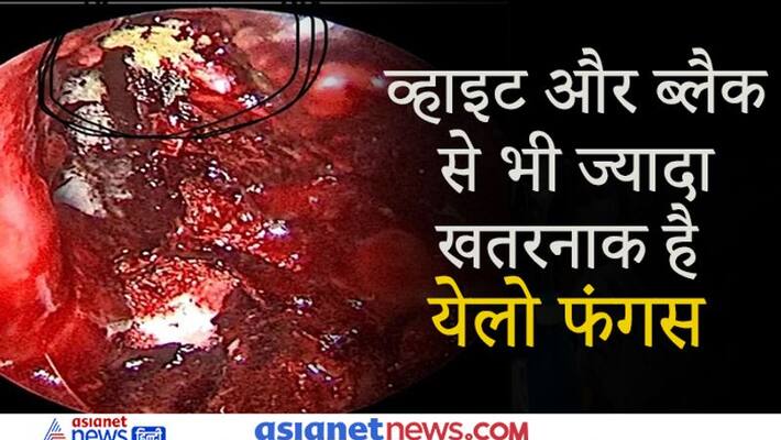 Yellow fungus reported in UP's Gaziabad in a man, Know all about DHA Yellow fungus reported in UP's Gaziabad in a man, Know all about DHA
