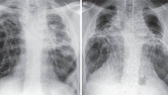 aspergillosis fungul cases are reporting in gujarat aspergillosis fungul cases are reporting in gujarat