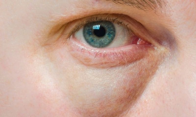 Corneal ulcers were one of the most serious infections during the monsoon. What happens is that the cornea develops an open sore, and if wrongly medicated, it can lead to blindness. The symptoms include extreme pain, pus discharge and blurred vision. It immediately requires the attention of an eye specialist and treatment should not be delayed.
