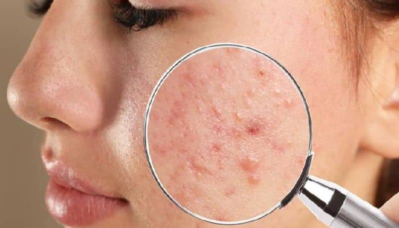 how to remove dark mark patches at home naturally BRD