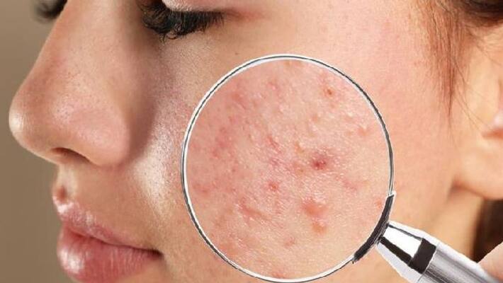 few home remedies for acne few home remedies for acne