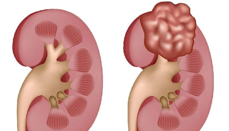kidney cancer is comparatively more seen in males than females