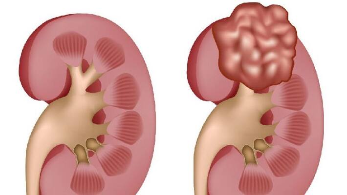 study says that covid 19 may lead to severe kidney ailments study says that covid 19 may lead to severe kidney ailments