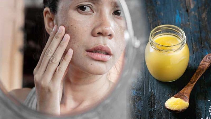 सुंदरता बढ़ाए घी
हजारों सालों से घी का इस्तेमाल खूबसूरती बनाए रखने के लिए किया जाता है। इसका जिक्र आयुर्वेद में भी है। इसमें मौजूद फैटी एसिड एक पौष्टिक एजेंट के रूप में काम करते हैं जो आपकी रूखी-सूखी त्वचा पर चमक ला सकते हैं। घी सभी प्रकार की त्वचा के लिए फायदेमंद है। मुलायम और कोमल त्वचा पाने के लिए यहां घी का उपयोग फेस पर करना चाहिए। आप इससे चेहरे की मालिश कर सकते हैं। अगर आप फटे होठों से हमेशा परेशान रहते है, तो आप नाभी पर सोते समय थोड़ा सा घी जरूर लगाएं। इससे आपके होठ कोमल हो जाएंगे, साथ ही फेस पर भी ग्लो आएगा।