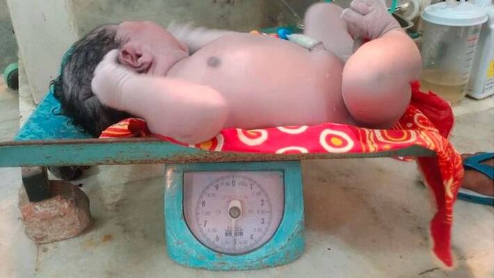5 kg baby born in Assams Cachar district kpn 5 kg baby born in Assams Cachar district kpn