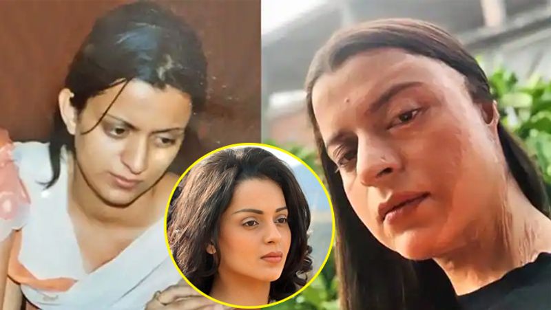 कंगना ने योग दिवस पर सोशल मीडिया पर एक पोस्ट शेयर करते हुए लिखा- जब रंगोली 21 साल की थी तो एक मनचले ने उस पर एसिड फेंक दिया था। इससे रंगोली का आधा चेहरा झुलस गया, एक आंख की रोशनी चली गई, बायां कान जख्मी हो गया गया और एक ब्रेस्ट गंभीर रूप से डैमेज हो गया था। 2-3 साल में उसे 53 सर्जरी से गुजरना पड़ा। लेकिन बावजूद इसके सबकुछ पहले जैसा नहीं हुआ। रंगोली पर करीब एक लीटर तेजाब फेंका गया था।
