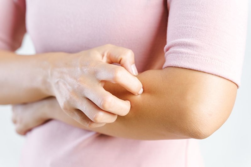 Though the exact cause of eczema is unknown, it's thought to be linked to the reaction by the body's immune system to an irritant. Eczema generally occurs in families who have a history of other allergies or asthma. The defects in the skin barrier could allow moisture to exit and bring in germs in our body. People can effectively manage this disease with medical treatment and by avoiding irritants. Here are some home remedies to cure eczema.