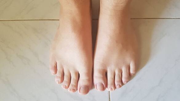 swollen face or hands and feet may be the sign of water retention 