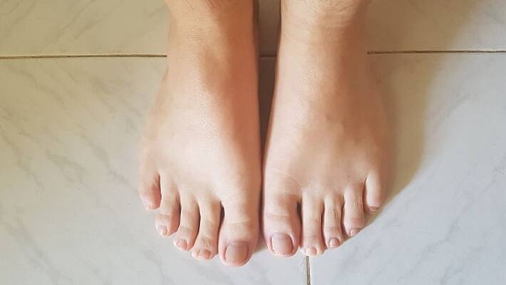 swollen face or hands and feet may be the sign of water retention swollen face or hands and feet may be the sign of water retention