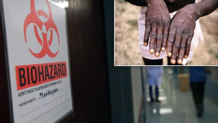 USA first time in 20 years case of monkeypox found in Texas kpn USA first time in 20 years case of monkeypox found in Texas kpn